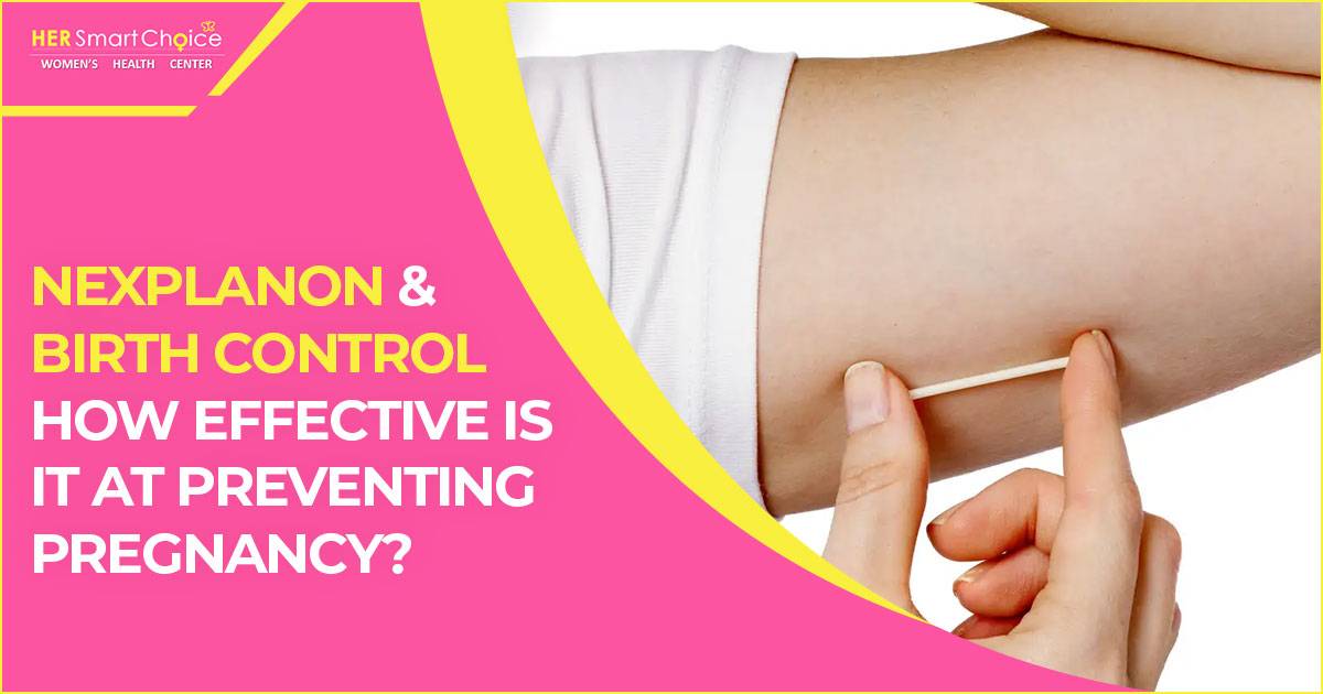 Nexplanon and birth control