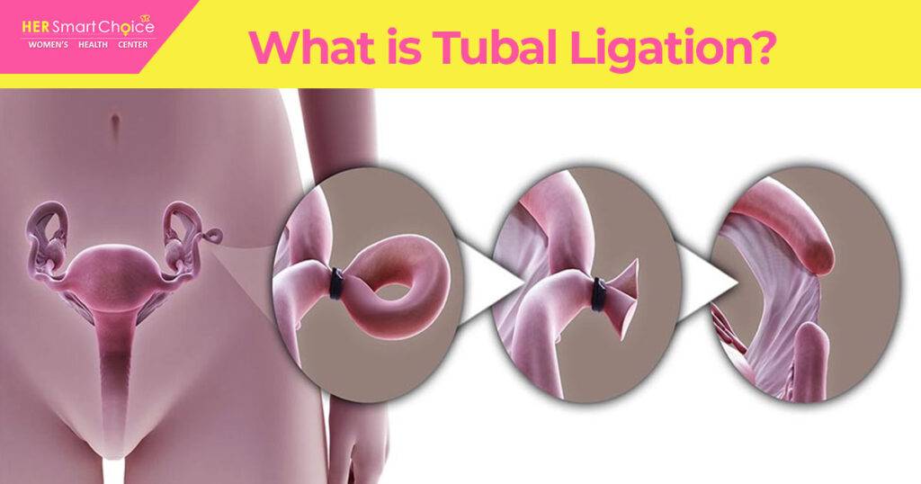 what is tubal ligation