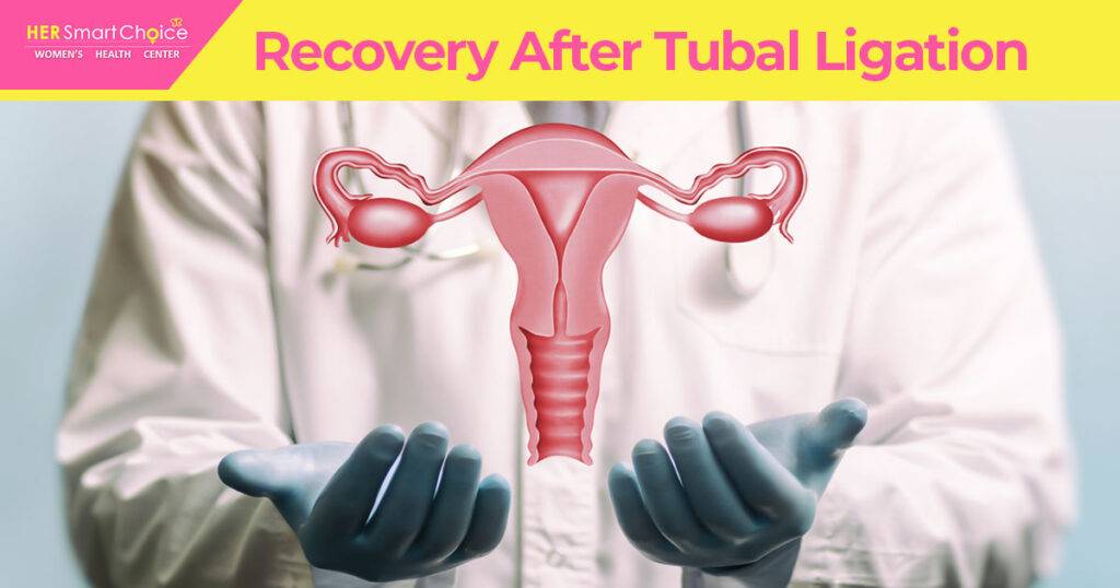 recovery after tubal ligation